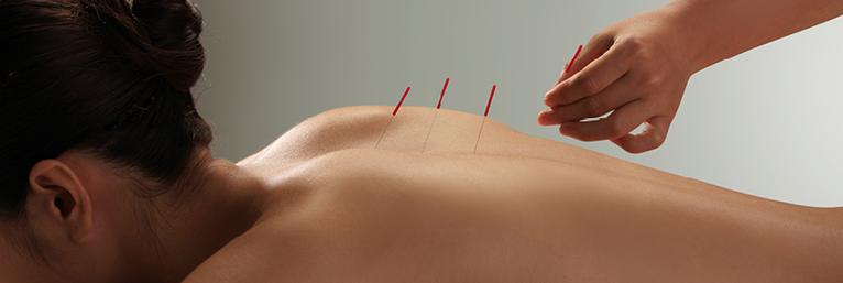 Agulhas de acupuntura SEIRIN