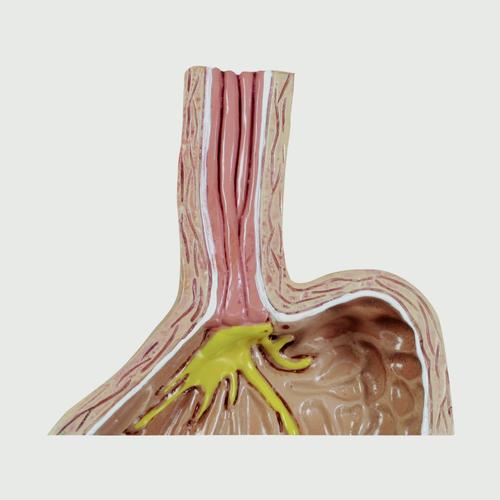 Modelo de enfermedad por reflujo gastroesofágico (GERD), 4 piezas, 1019525, Modelos del Sistema Digestivo