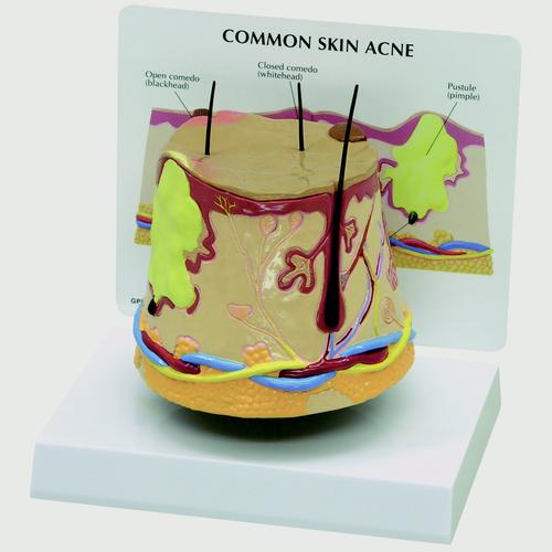 Modelo de acné cutáneo (ampliado), 1019567, Modelos de Piel