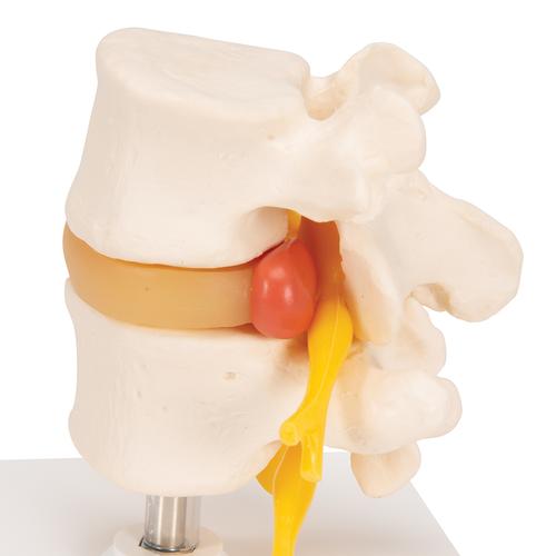 Discos vertebrales lumbares con hernia discal - 3B Smart Anatomy, 1000149 [A76], Modelos de vértebras