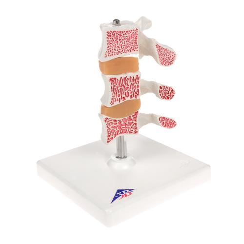 Modelo de osteoporosis – Versión de Lujo (3 Vertebrales) - 3B Smart Anatomy, 1000153 [A78], Educación sobre artritis y osteoporosis