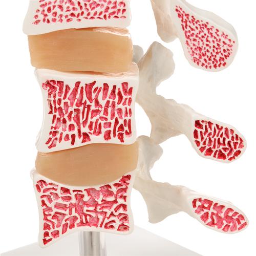 Modelo de osteoporosis – Versión de Lujo (3 Vertebrales) - 3B Smart Anatomy, 1000153 [A78], Modelos de vértebras