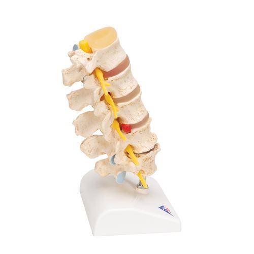 Estadios del prolapso del cartílago interventeral y de la degeneración vertebral - 3B Smart Anatomy, 1000158 [A795], Modelos de vértebras