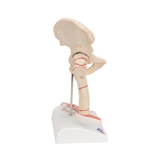 Fractura de fémur y desgaste de la articulación de la cadera - 3B Smart Anatomy, 1000175 [A88], Modelos de Articulaciones