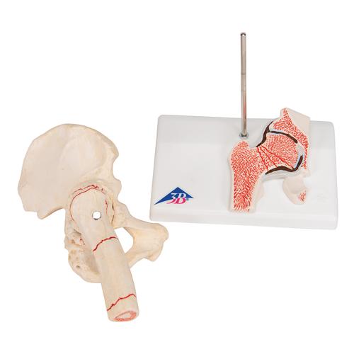 Fractura de fémur y desgaste de la articulación de la cadera - 3B Smart Anatomy, 1000175 [A88], Modelos de Articulaciones