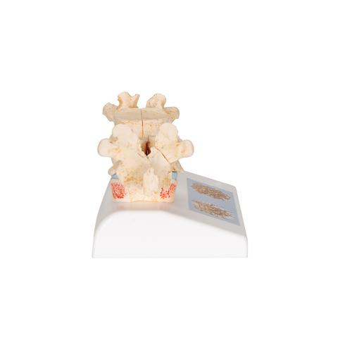 Modelo de osteoporosis - 3B Smart Anatomy, 1000182 [A95], Modelos de Columna vertebral