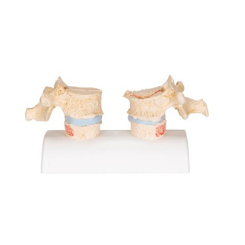 Modelo de osteoporosis - 3B Smart Anatomy, 1000182 [A95], Modelos de vértebras