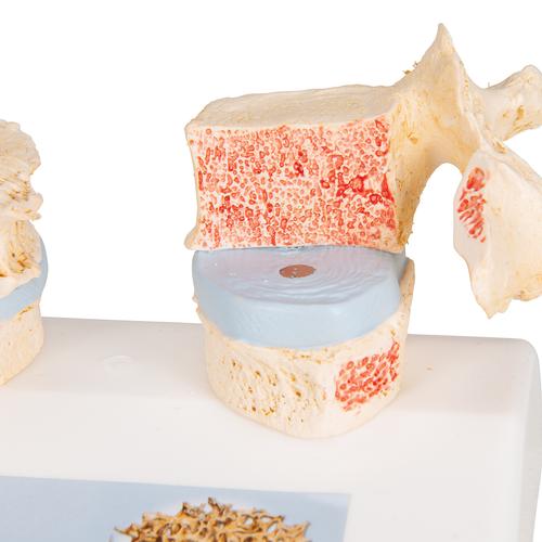 Modelo de osteoporosis - 3B Smart Anatomy, 1000182 [A95], Educación sobre artritis y osteoporosis