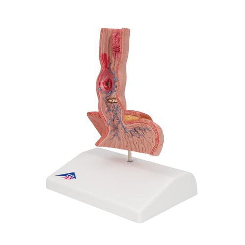 Enfermedades del esófago - 3B Smart Anatomy, 1000305 [K18], Modelos del Sistema Digestivo