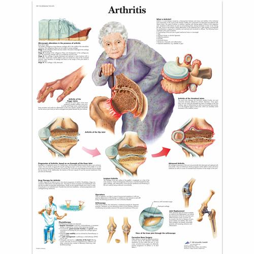 Arthritis, 4006654 [VR1123UU], Educación sobre artritis y osteoporosis