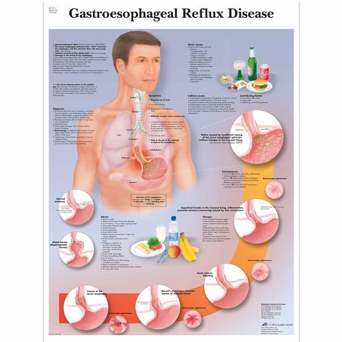 Gastroesophageal reflux disease, 4006718 [VR1711UU], El sistema digestivo