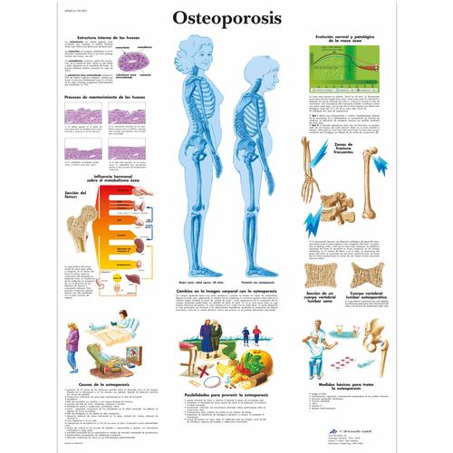 Osteoporosis, 4006816 [VR3121UU], Sistema Esquelético