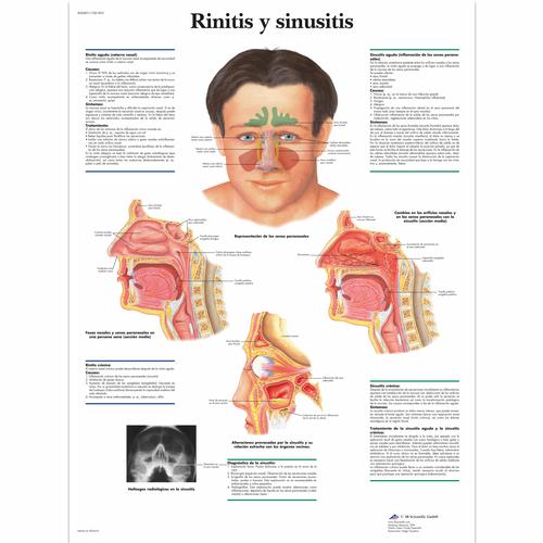 Rinitis y sinusitis, 4006831 [VR3251UU], Oreja, Nariz, Garganta