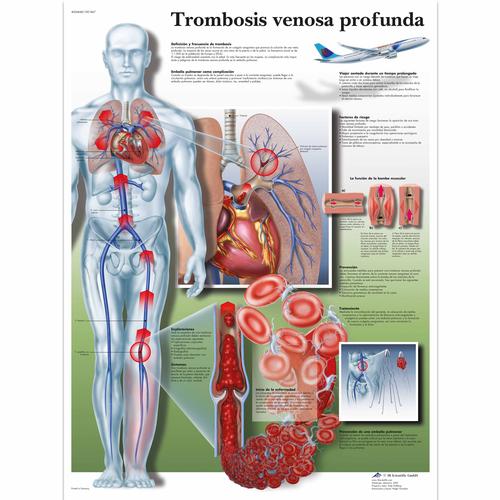Trombosis venosa profunda, 4006848 [VR3368UU], Sistema Cardiovascular