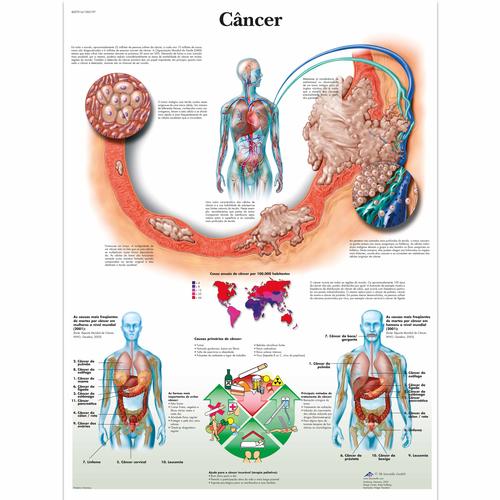 Câncer, 4007014 [VR5753UU], Los tipos de cáncer