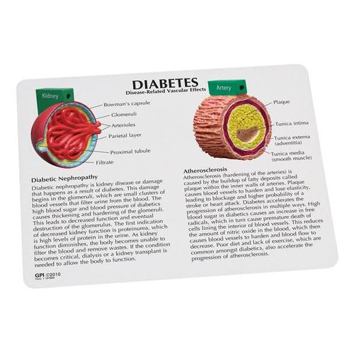 Modelo de diabetes de 4 piezas, 1019574 [W33387], Herramientas educativas para diabetes
