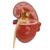 Modelo de riñón enfermo, 1019550, Modelos del Sistema Digestivo (Small)