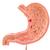 Estómago con úlceras gástricas - 3B Smart Anatomy, 1000304 [K17], Modelos del Sistema Digestivo (Small)
