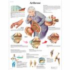 Arthrose, 1001308 [VR0123L], Educación sobre artritis y osteoporosis