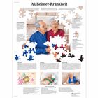 Alzheimer-Krankheit, 1001428 [VR0628L], Cerebro y sistema nervioso