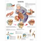 Pôster da Artrite, 4006654 [VR1123UU], Informações sobre artrite e osteoporose