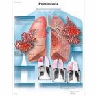 Pneumonia, 1001518 [VR1326L], Parasitarias, virales e infecciones bacterianas