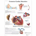 Pôster dos Distúrbios Cardíacos Comuns, 1001526 [VR1343L], Sistema Cardiovascular