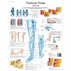 Varicose Veins, 1001534 [VR1367L], Sistema Cardiovascular