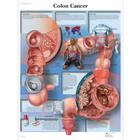 Colon Cancer, 1001550 [VR1432L], Los tipos de cáncer