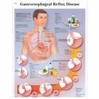 Gastroesophageal reflux disease, 4006718 [VR1711UU], Sistema digestivo