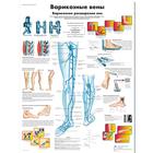Медицинский плакат "Варикозные вены", 1002276 [VR6367L], Sistema circulatorio
